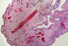 Multiple-sclerosis-placental-cells