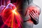 infarctul miocardic