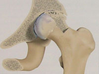 Artroza este o suferinta a cartilajului articular