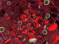 Leucemia este un cancer al celulelor sangelui