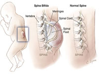 Spina Bifida desemneaza un defect al coloanei vertebrale