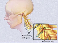 Spondiloza cervicala este o afectiune a coloanei vertebrale