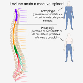 Leziune acuta a maduvei spinarii